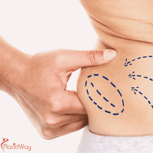 Liposucción 12345 en Colombia: ¿Por qué pacientes de EE. UU. y Canadá eligen Bogotá y Medellín para la remodelación corporal?